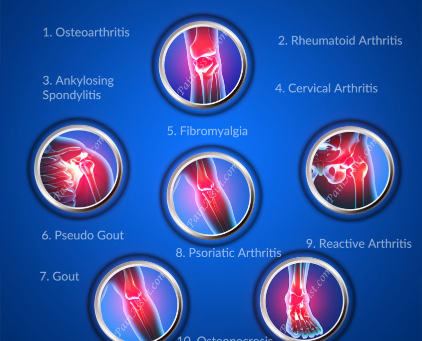Arthritis and physical activity Vistasol Medical Group